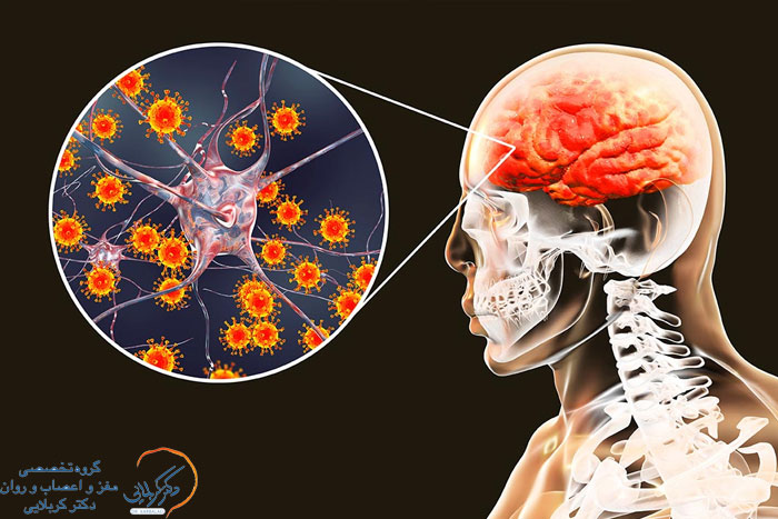 علائم آنسفالیت مغزی